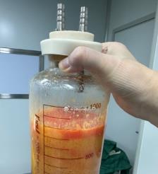 沂源水动力吸脂手术要做多久？